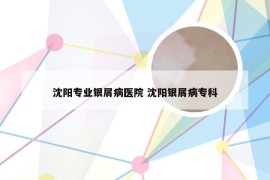 沈阳专业银屑病医院 沈阳银屑病专科