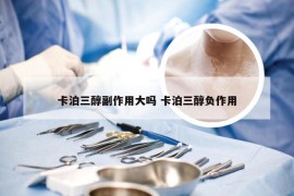 卡泊三醇副作用大吗 卡泊三醇负作用
