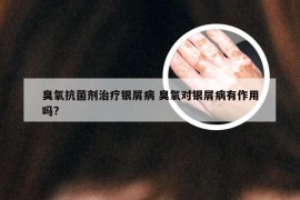 臭氧抗菌剂治疗银屑病 臭氧对银屑病有作用吗?