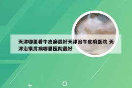 天津哪里看牛皮癣最好天津治牛皮癣医院 天津治银屑病哪里医院最好