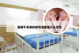 我国牛皮癣的研究成果是什么意思