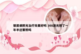 银屑病照光治疗效果好吗 308激光照了一年半还要照吗