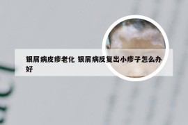 银屑病皮疹老化 银屑病反复出小疹子怎么办好
