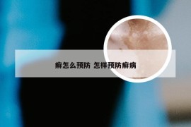 癣怎么预防 怎样预防癣病