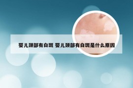 婴儿颈部有白斑 婴儿颈部有白斑是什么原因