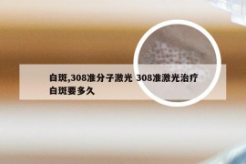 白斑,308准分子激光 308准激光治疗白斑要多久
