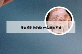 什么癣扩散的快 什么癣治不好