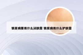 银屑病要用什么润肤露 银屑病用什么护肤霜