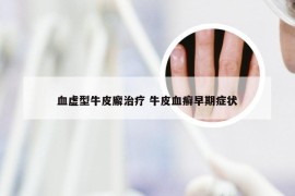 血虚型牛皮廨治疗 牛皮血癣早期症状