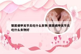 银屑病甲关节炎吃什么食物 银屑病甲关节炎吃什么食物好