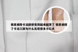 银屑病擦卡泊醇即变得越来越薄了 银屑病擦了卡泊三醇为什么出现很多小红点