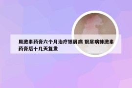 用激素药膏六个月治疗银屑病 银屑病抹激素药膏后十几天复发