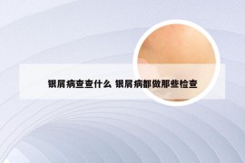 银屑病查查什么 银屑病都做那些检查