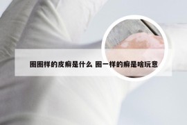 圈圈样的皮癣是什么 圈一样的癣是啥玩意