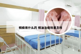 桐癣用什么药 桐油治癣效果怎样
