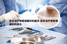 南京治疗银屑病最好的医生 南京治疗银屑病最好的地方