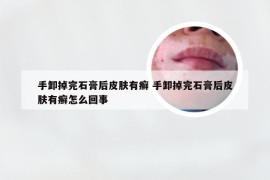 手卸掉完石膏后皮肤有癣 手卸掉完石膏后皮肤有癣怎么回事
