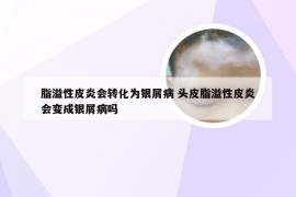 脂溢性皮炎会转化为银屑病 头皮脂溢性皮炎会变成银屑病吗