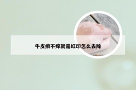 牛皮癣不痒就是红印怎么去除