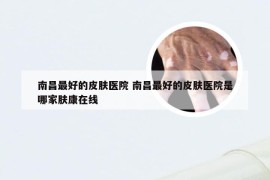 南昌最好的皮肤医院 南昌最好的皮肤医院是哪家肤康在线