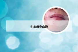 牛皮癣查血液