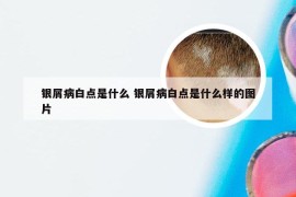 银屑病白点是什么 银屑病白点是什么样的图片