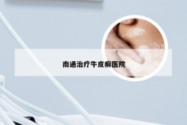 南通治疗牛皮癣医院