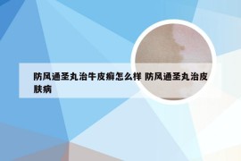 防风通圣丸治牛皮癣怎么样 防风通圣丸治皮肤病