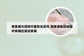 银屑病与结核杆菌有关系吗 银屑病是结缔组织疾病还是皮肤病