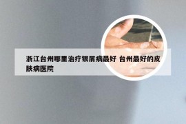 浙江台州哪里治疗银屑病最好 台州最好的皮肤病医院