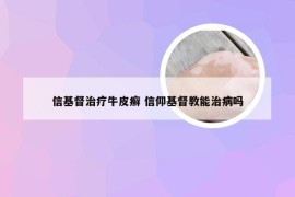 信基督治疗牛皮癣 信仰基督教能治病吗