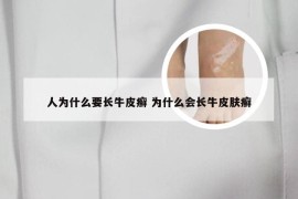 人为什么要长牛皮癣 为什么会长牛皮肤癣