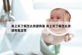 身上长了癣怎么快速恢复 身上长了癣怎么快速恢复正常