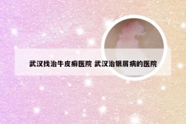 武汉找治牛皮癣医院 武汉治银屑病的医院