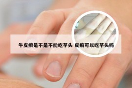 牛皮癣是不是不能吃芋头 皮癣可以吃芋头吗
