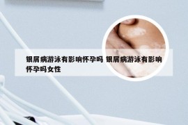 银屑病游泳有影响怀孕吗 银屑病游泳有影响怀孕吗女性