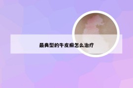最典型的牛皮癣怎么治疗
