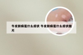 牛皮肤癣是什么症状 牛皮肤癣是什么症状图片