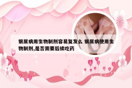 银屑病用生物制剂容易复发么 银屑病使用生物制剂,是否需要后续吃药