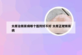 太原治银屑病哪个医院好不好 太原正规银屑病