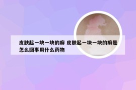 皮肤起一块一块的癣 皮肤起一块一块的癣是怎么回事用什么药物