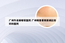 广州牛皮癣哪家医院 广州哪里看银屑病比较好的医院