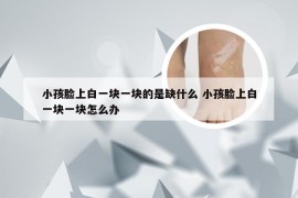 小孩脸上白一块一块的是缺什么 小孩脸上白一块一块怎么办