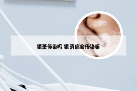 银萧传染吗 银消病会传染嘛