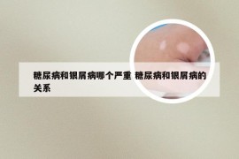 糖尿病和银屑病哪个严重 糖尿病和银屑病的关系