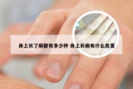身上长了癣都有多少种 身上长癣有什么危害