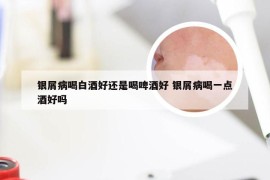 银屑病喝白酒好还是喝啤酒好 银屑病喝一点酒好吗