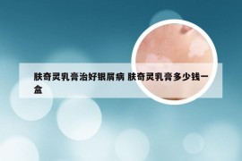 肤奇灵乳膏治好银屑病 肤奇灵乳膏多少钱一盒