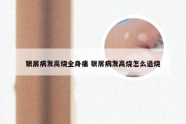 银屑病发高烧全身痛 银屑病发高烧怎么退烧