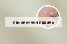 灵芝对银屑病有帮助吗 灵芝治银屑病